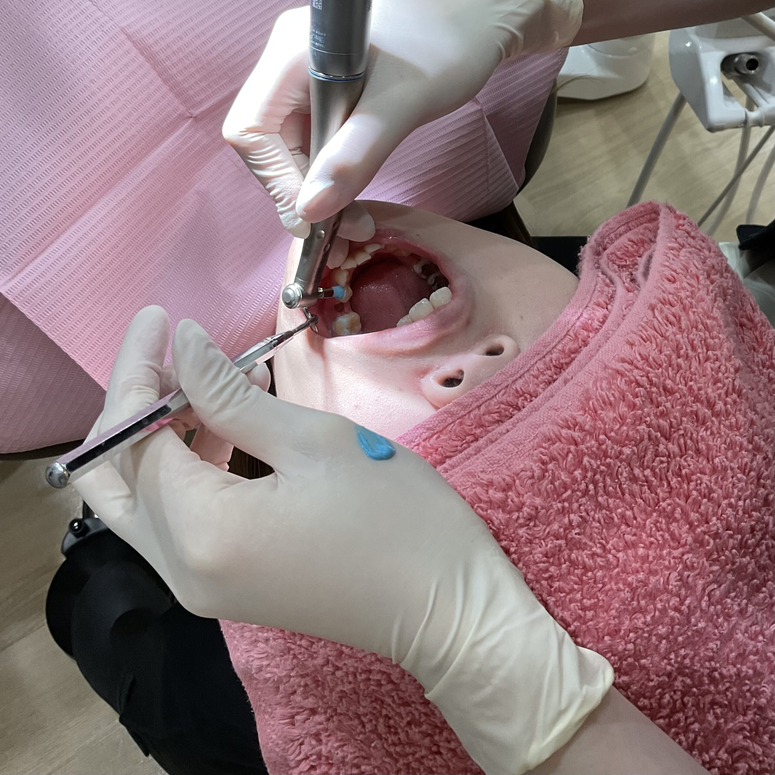 歯科用3Dプリンターを用いたインダイレクトボンディング法とは