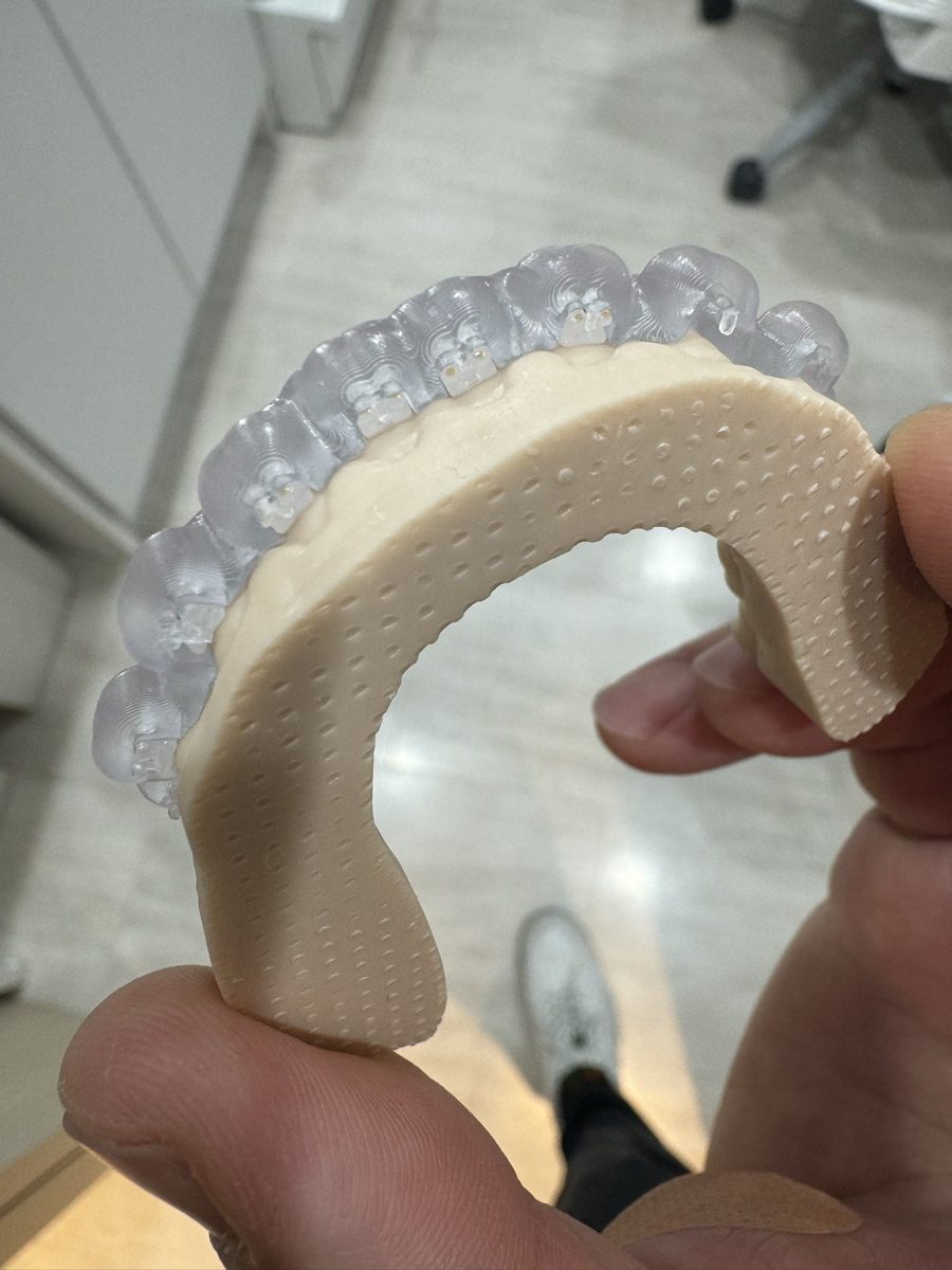 3Dプリンタ製の模型で作られたマウスピース