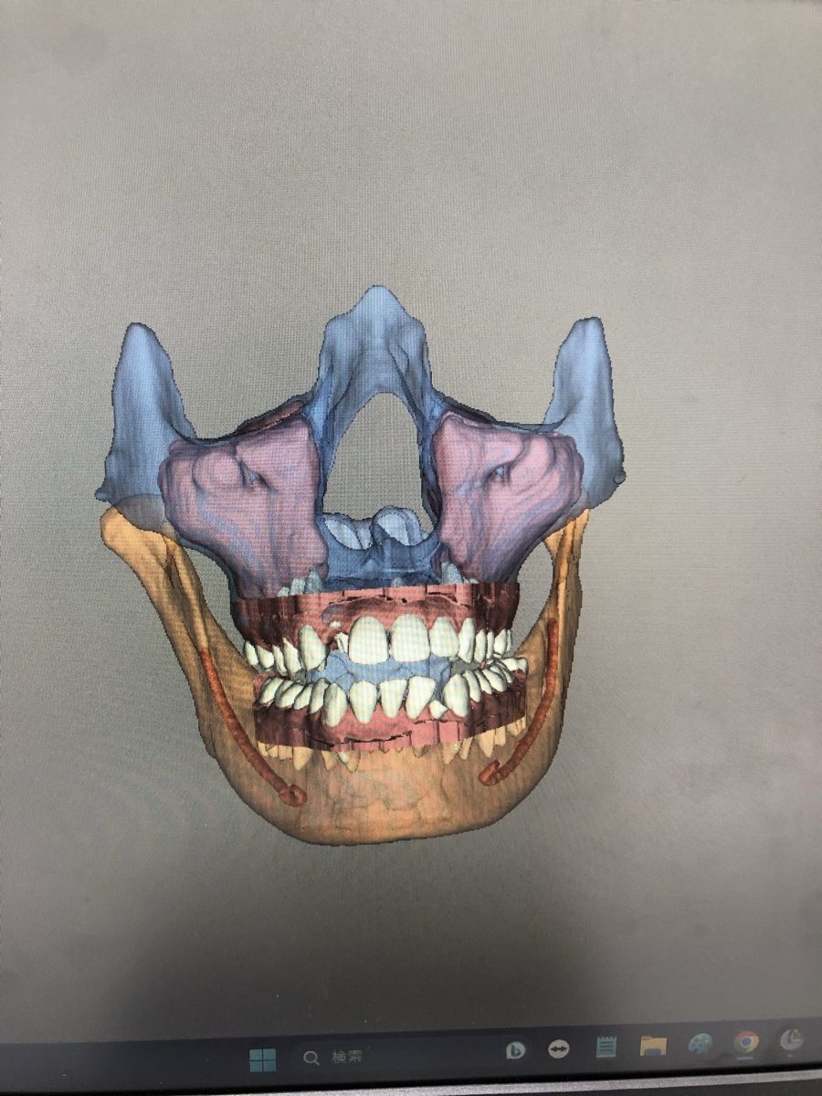 歯科用CTの3D画像