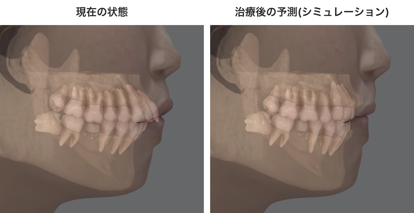 3Dフェイススキャンによる口元のシミュレーション画像(左:現在の状態/右:治療後の予測)。予測であり実際の変化には個人差があります